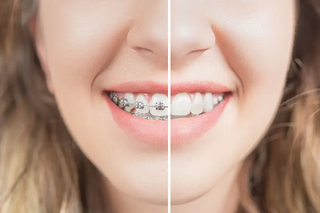 What To Do If Your Teeth Are Shifting After Braces 2021