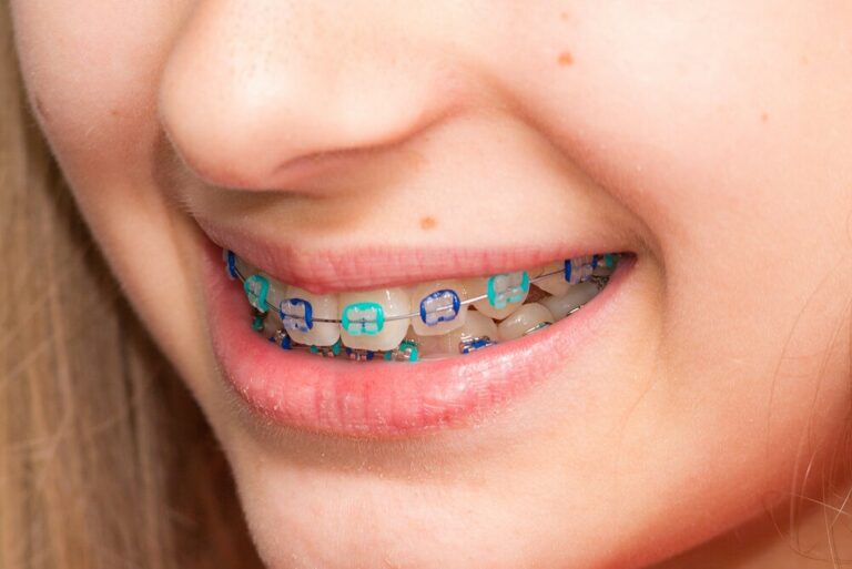 🥇 Choose the Best Colors for your Braces【 2021 】Good colors & Ideas